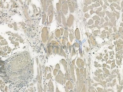 TAPBP Antibody - DF6723 at 1/100 staining human tongue carcinoma by IHC-P.