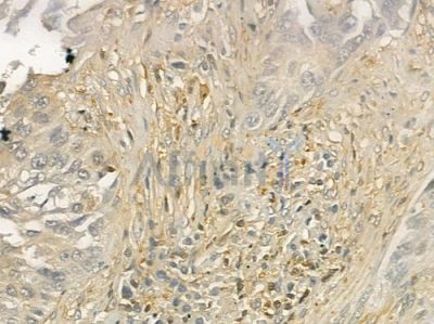 CD244 Antibody - DF6741 at 1/100 staining human lung squamous cell carcinoma by IHC-P.