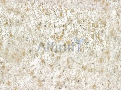 RPS19 Antibody - DF6756 at 1/100 staining human astrocytoma by IHC-P.