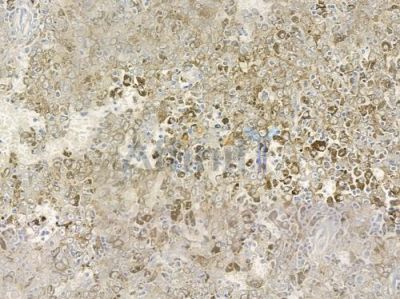 CD70 Antibody - DF6766 at 1/100 staining human melanoma by IHC-P.
