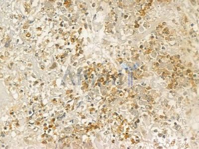 CSF2RA Antibody - DF6768 at 1/100 staining human prostate carcinoma by IHC-P.