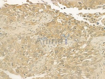 KLRD1 Antibody - DF6773 at 1/100 staining human lung squamous cell carcinoma by IHC-P.
