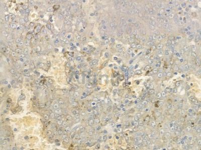 SLAM / CD150 Antibody - DF6776 at 1/100 staining human melanoma by IHC-P.
