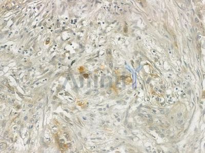CD69 Antibody - DF6777 at 1/100 staining human cervical carcinoma by IHC-P.