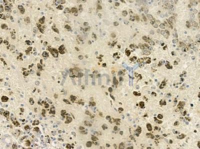 cdc45 Antibody - DF6779 at 1/100 staining human melanoma by IHC-P.