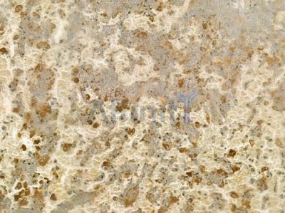 GRK3 Antibody - DF6780 at 1/100 staining human melanoma by IHC-P.