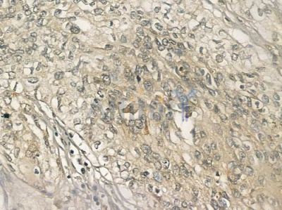 LCN2 Antibody - DF6816 at 1/100 staining human lung squamous cell carcinoma by IHC-P.