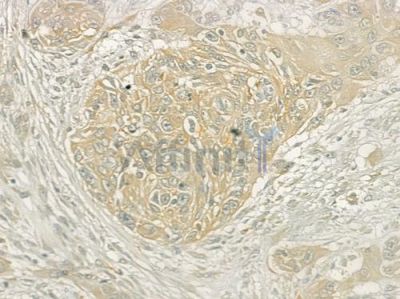 Osteoprotegerin Antibody - DF6824 at 1/100 staining human tongue carcinoma by IHC-P.