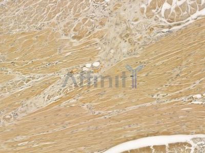 PDE1B Antibody - DF6826 at 1/100 staining human tongue carcinoma by IHC-P.