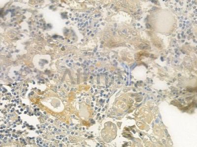 SPAM1 Antibody - DF6844 at 1/100 staining human thyroid carcinoma by IHC-P.