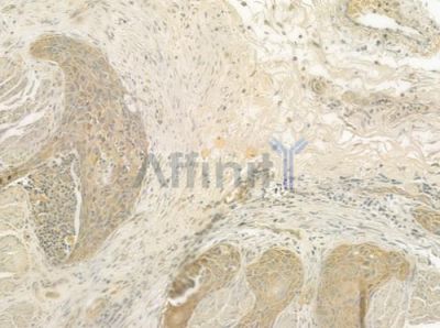 TNFSF10 Antibody - DF6861 at 1/100 staining human esophageal carcinoma by IHC-P.