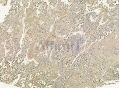 SCN4B Antibody - DF6877 at 1/100 staining human lung squamous cell carcinoma by IHC-P.