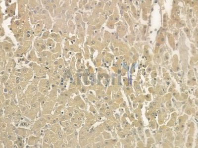 HCLS1 Antibody - DF6888 at 1/100 staining human hepatocellular carcinoma by IHC-P.