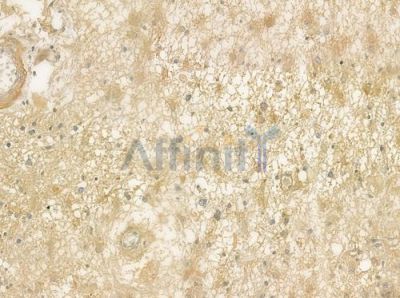 NPPB Antibody - DF6902 at 1/100 staining human astrocytoma by IHC-P.