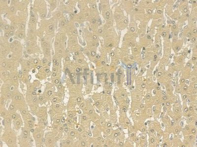 DLGAP5 Antibody - DF6920 at 1/100 staining human hepatocellular carcinoma by IHC-P.