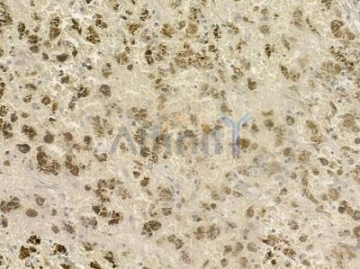 DNMT3L Antibody - DF6928 at 1/100 staining human melanoma by IHC-P.