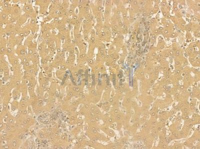 TTK Antibody - DF6969 at 1/100 staining human hepatocellular carcinoma by IHC-P.
