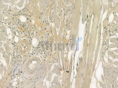 GNAO1 Antibody - DF6975 at 1/100 staining human tongue carcinoma by IHC-P.