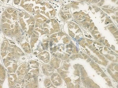 HNMT Antibody - DF6982 at 1/100 staining human renal cell carcinoma by IHC-P.