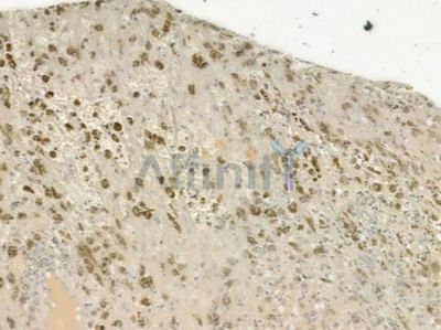 ACK1 Antibody - DF6987 at 1/100 staining human melanoma by IHC-P.
