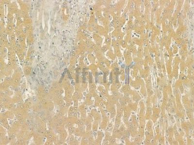 PRG2 Antibody - DF6992 at 1/100 staining human hepatocellular carcinoma by IHC-P.