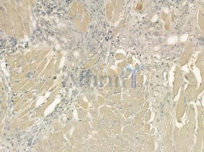 PRG2 Antibody - DF6992 at 1/100 staining human tongue carcinoma by IHC-P.