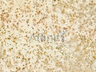 TMPO Antibody - DF6994 at 1/100 staining human melanoma by IHC-P.