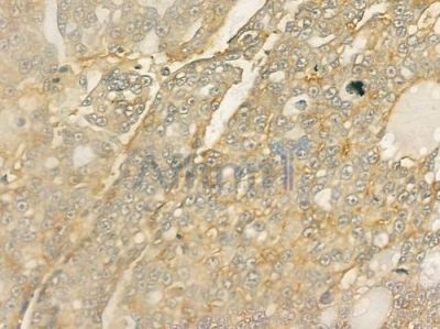 Integrin beta3 Antibody - DF6999 at 1/100 staining human ovarian carcinoma by IHC-P.