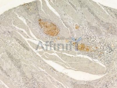 VEGFC Antibody - DF7011 at 1/100 staining human esophageal carcinoma by IHC-P.