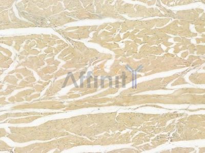 TGFBI Antibody - DF7015 at 1/100 staining human tongue carcinoma by IHC-P.