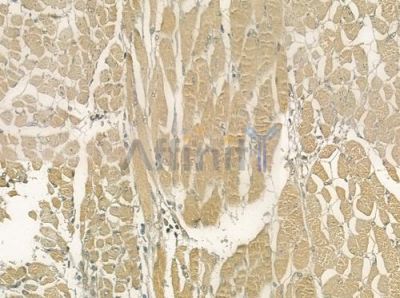 PRKG1 Antibody - DF7018 at 1/100 staining human tongue carcinoma by IHC-P.