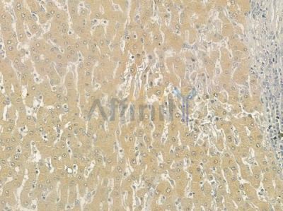 SLP76 Antibody - DF7020 at 1/100 staining human hepatocellular carcinoma by IHC-P.