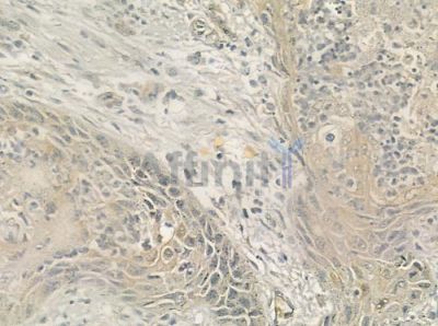 CCL28 Antibody - DF7045 at 1/100 staining human esophageal carcinoma by IHC-P.
