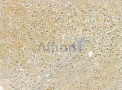 NRG4 Antibody - DF7046 at 1/100 staining human cervical carcinoma by IHC-P.