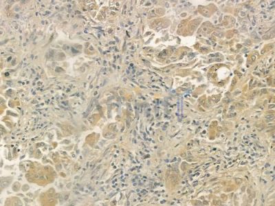 IL18R1 Antibody - DF7059 at 1/100 staining human lung adenocarcinoma by IHC-P.