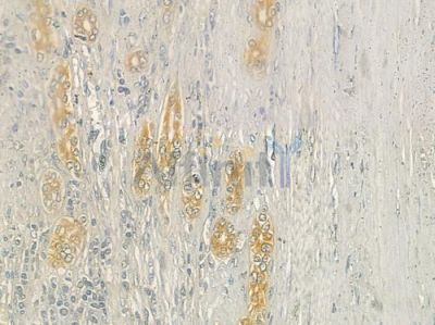 CDH23 Antibody - DF7079 at 1/100 staining human hepatocellular carcinoma by IHC-P.