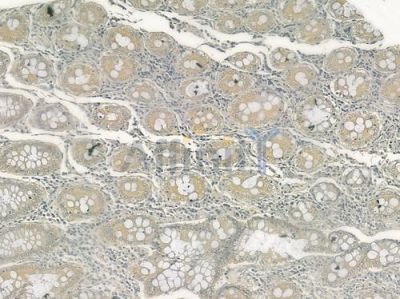 CDH23 Antibody - DF7079 at 1/100 staining human colon carcinoma by IHC-P.