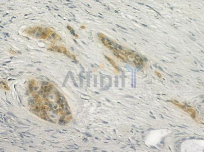 CDH23 Antibody - DF7079 at 1/100 staining human pancreatic carcinoma by IHC-P.