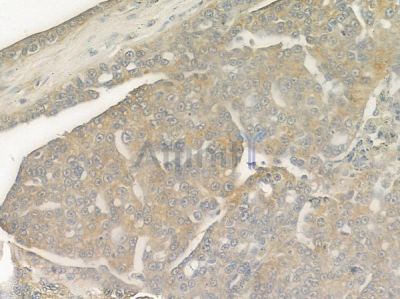 LAMP3 Antibody - DF7099 at 1/100 staining human ovarian carcinoma by IHC-P.