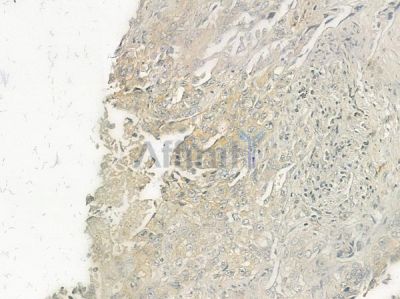 GRPR Antibody - DF7114 at 1/100 staining human lung squamous cell carcinoma by IHC-P.