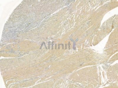 IGFBP7 Antibody - DF7131 at 1/100 staining human tongue carcinoma by IHC-P.