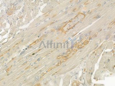 KCNA1 Antibody - DF7138 at 1/100 staining human tongue carcinoma by IHC-P.