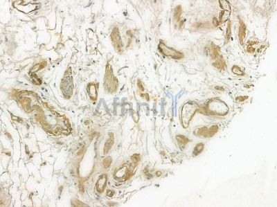 KCNA1 Antibody - DF7138 at 1/100 staining human small cell lung carcinoma by IHC-P.