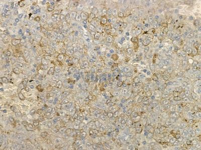 MMP25 Antibody - DF7151 at 1/100 staining human liver cancer by IHC-P.