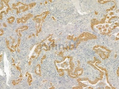 MMP11 Antibody - DF7153 at 1/100 staining human lung adenocarcinoma by IHC-P.