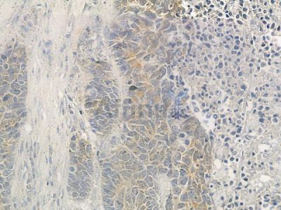 MMP11 Antibody - DF7153 at 1/100 staining human large cell lung carcinoma by IHC-P.
