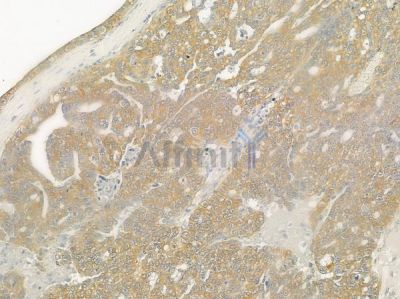MMP11 Antibody - DF7153 at 1/100 staining human ovarian carcinoma by IHC-P.