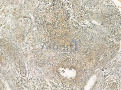 NFASC Antibody - DF7160 at 1/100 staining human cervical carcinoma by IHC-P.
