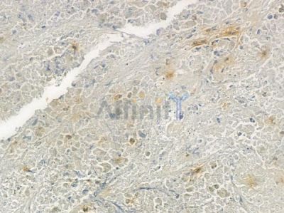 P2RY4 Antibody - DF7163 at 1/100 staining human lung squamous cell carcinoma by IHC-P.