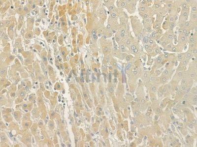 P2RY11 Antibody - DF7164 at 1/100 staining human hepatocellular carcinoma by IHC-P.